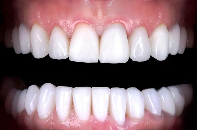 Perfect smile whitening before and after veneers bleach of zirco
