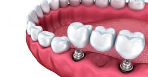  dental implants in Istanbul