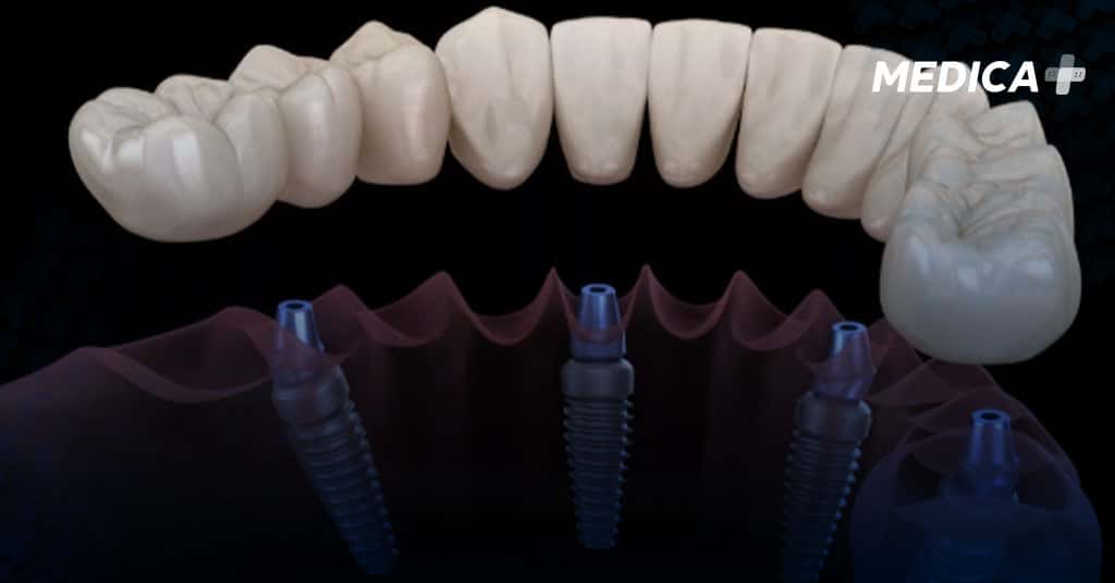 dental implants in Istanbul