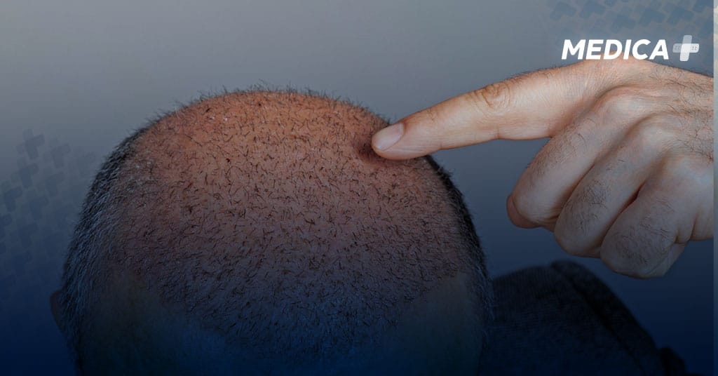 Is the cost of hair transplantation in Turkey high?