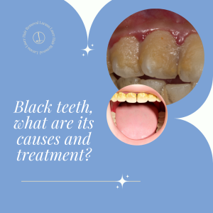 Black teeth, what are its causes and treatment