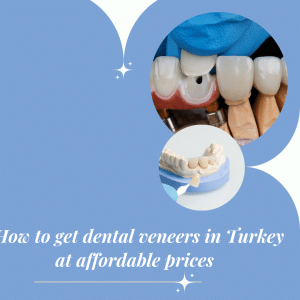 How to get dental veneers in Turkey at affordable prices