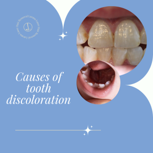 Causes of tooth discoloration