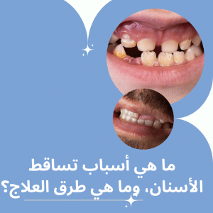 ما هي أسباب تساقط الأسنان، وما هي طرق العلاج؟