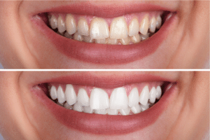 Teeth whitening costs in Turkey