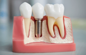 Dental implant costs in Turkey 