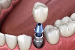 Stages of dental implants in Turkey