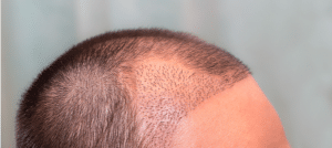 Hair transplantation in Turkey for women 