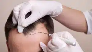 زراعة الشعر في تركيا