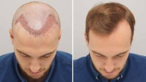 hair transplantation in Turkey