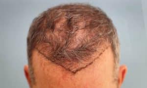 تكاليف زراعة الشعر في تركيا